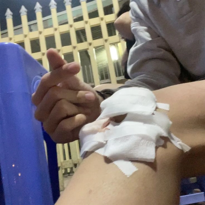 Ảnh ngã xe trầy đầu gối đau nhói