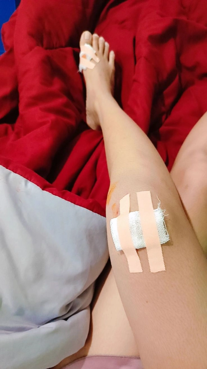 Hình ảnh ngã xe xước chân nữ
