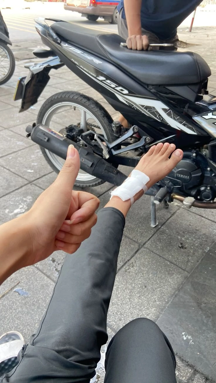 Hình ảnh vết thương ngã xe xước
